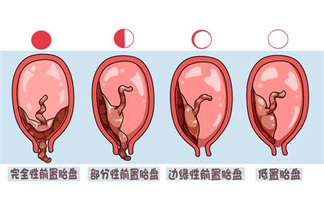 前置胎盤原因|前置胎盘